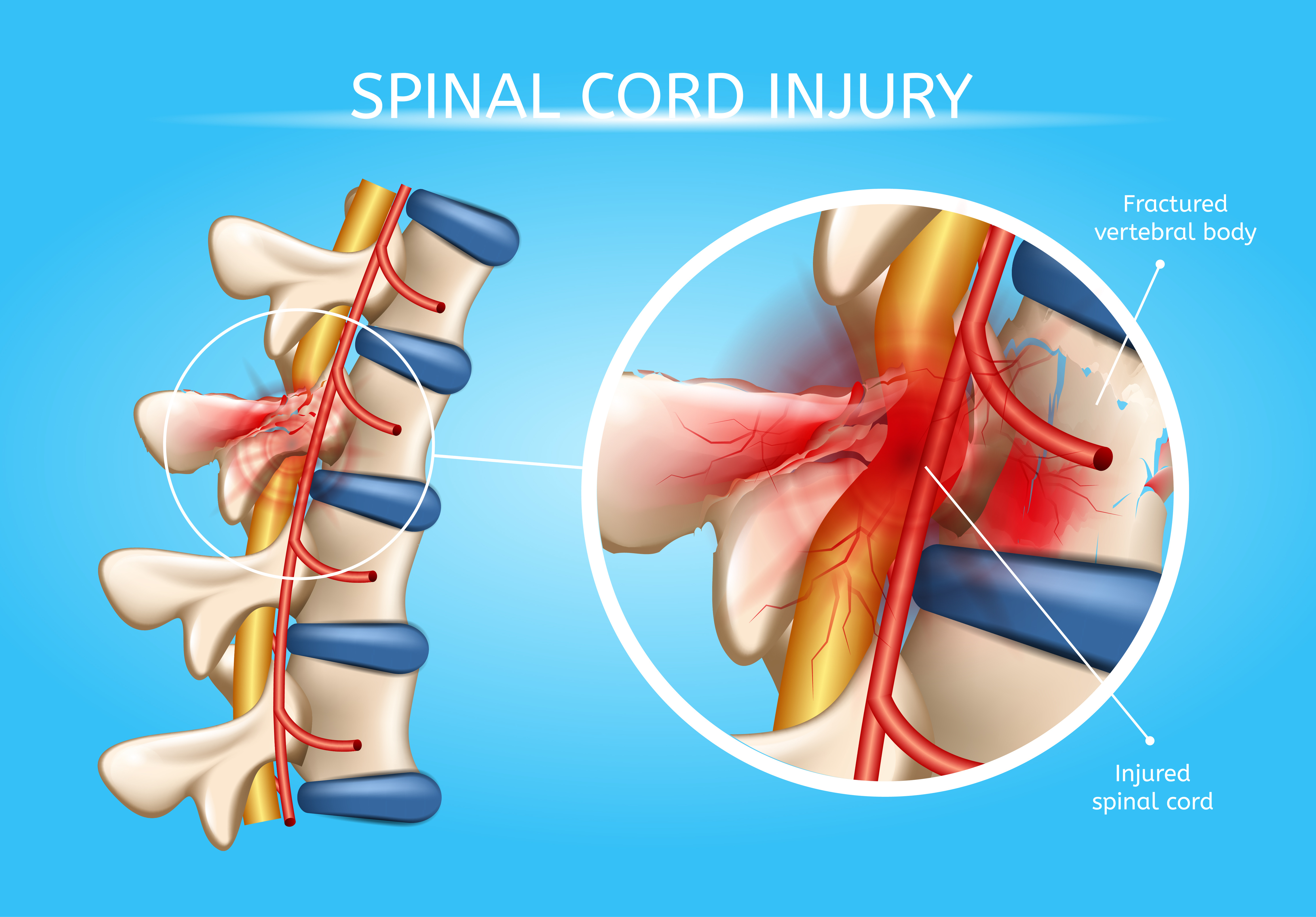 Miami Spinal Cord Injury Lawyer