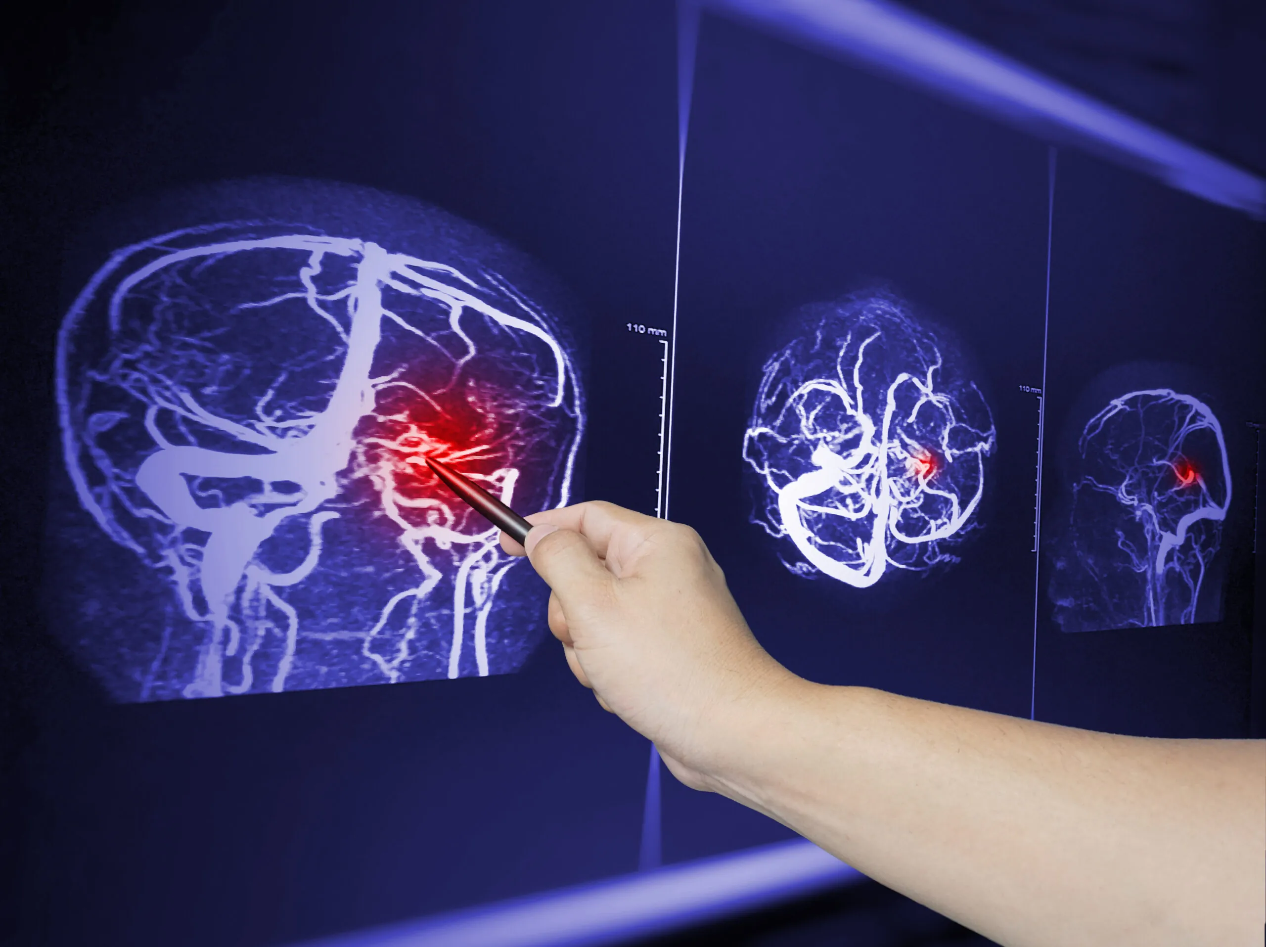 When Brain Injury Symptoms Evolve After Virginia Truck Accidents